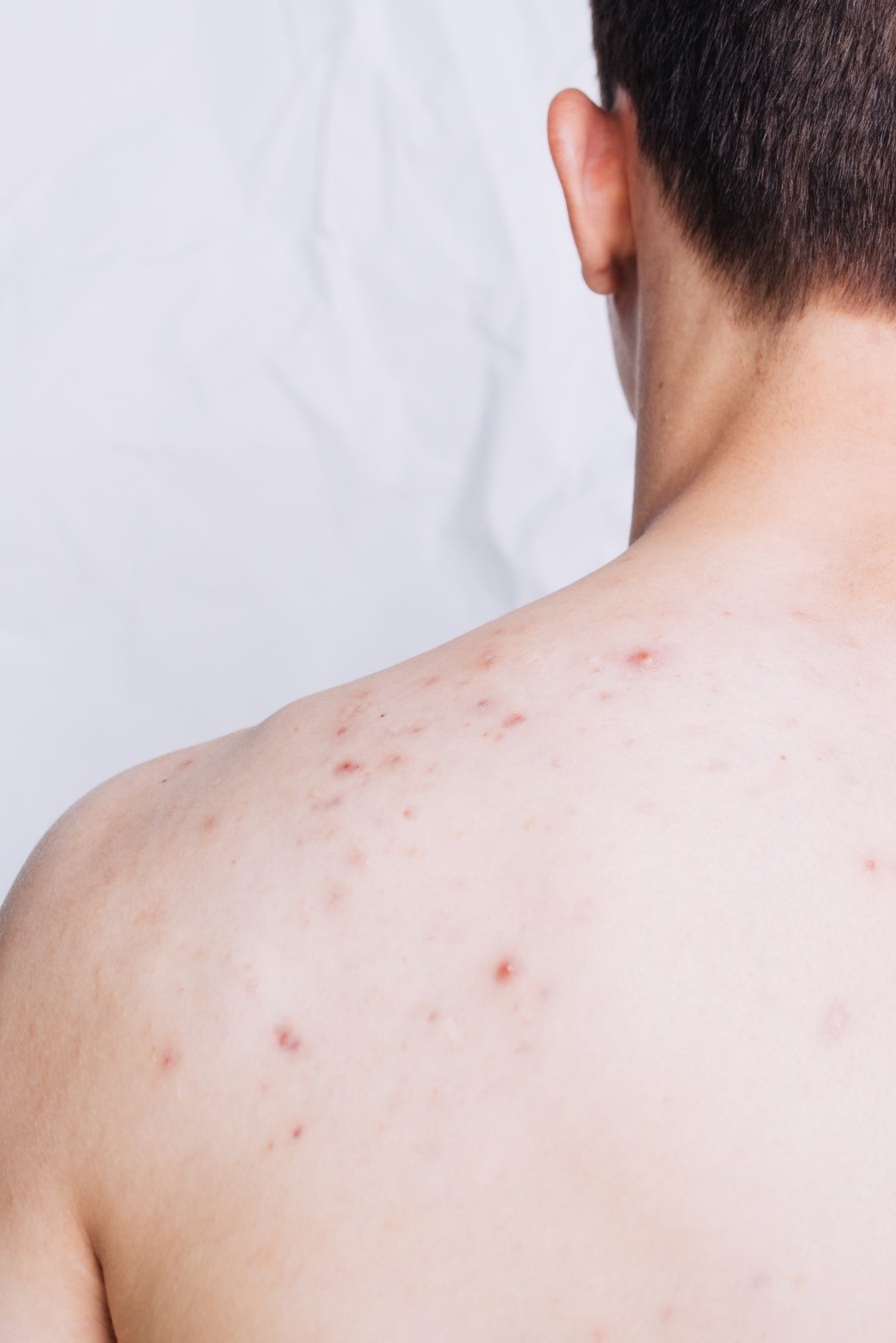 Sering Olahraga Bikin Jerawat Punggung? Pakai TOTAL CARE MEN